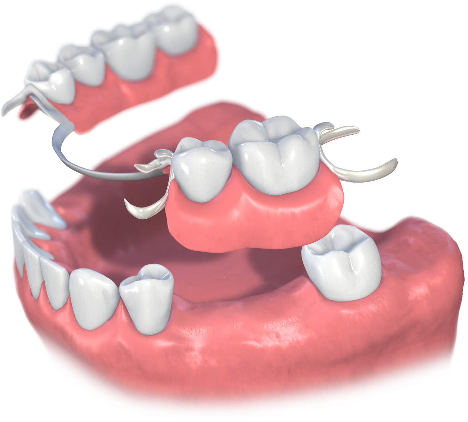 部分 入れ歯 の 種類