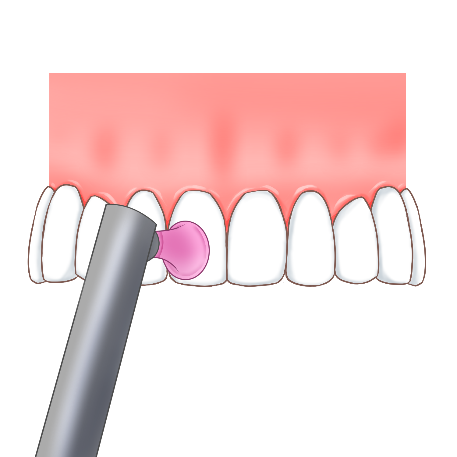 歯の表面をツルツルに仕上げ磨きします