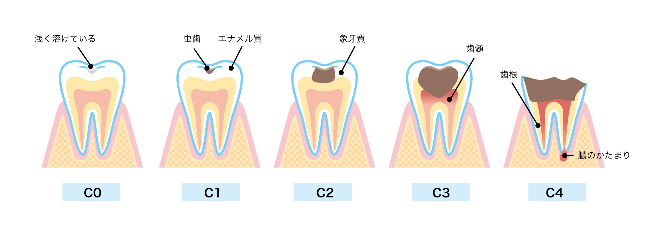 虫歯 の 進行 イラスト