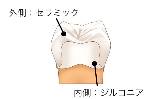 ジルコニアセラミック